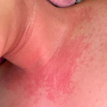 Sephora’nın Tester Ürünü Nedeniyle Şiddetli Alerjik Reaksiyon Ve Cevapsızlık