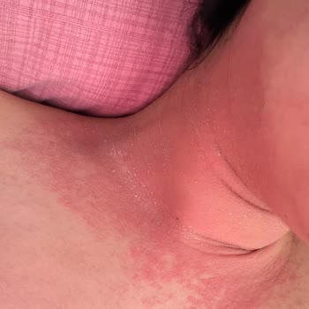 Sephora’nın Tester Ürünü Nedeniyle Şiddetli Alerjik Reaksiyon Ve Cevapsızlık