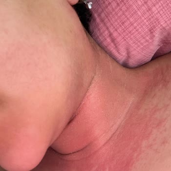 Sephora’nın Tester Ürünü Nedeniyle Şiddetli Alerjik Reaksiyon Ve Cevapsızlık