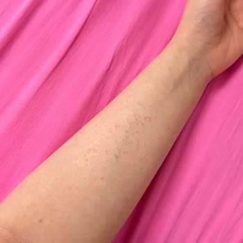 Sephora’nın Tester Ürünü Nedeniyle Şiddetli Alerjik Reaksiyon Ve Cevapsızlık