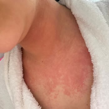 Sephora’nın Tester Ürünü Nedeniyle Şiddetli Alerjik Reaksiyon Ve Cevapsızlık