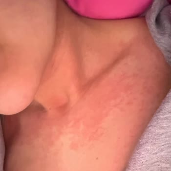 Sephora’nın Tester Ürünü Nedeniyle Şiddetli Alerjik Reaksiyon Ve Cevapsızlık