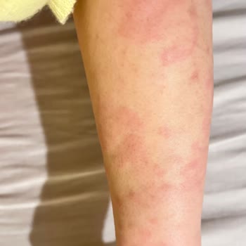 Yoğun Yanma Ve Şişlik Nedeniyle Nivea Duş Jelinin İadesi Talebi