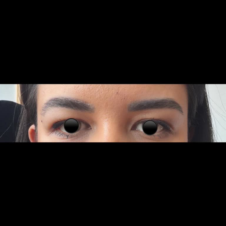 Botoks Sonrası Yan Etkiler Ve Kötü Hizmet