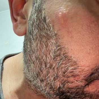 Medical Park İzmir’de Yüz Lazer İşlemi Sonrası Ciddi Yanık Ve Yarım Kalan Tedavi