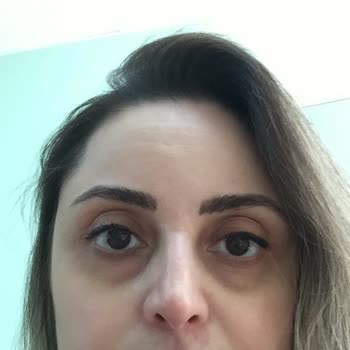 Microblading Sonrası Kaşlarda Yapay Kızıl Renk Ve İade Talebi