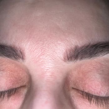 Microblading Sonrası Kaşlarda Yapay Kızıl Renk Ve İade Talebi