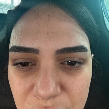 Göz Altı Kamuflajı Sonuç Vermedi Ve Ücret İadesi Talebi