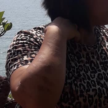Rosso Beauty Bağcılar Şubesinde Yanıklar Ve Sınırsız Seans Sözünün İhlali