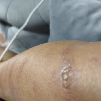 Rosso Beauty Bağcılar Şubesinde Yanıklar Ve Sınırsız Seans Sözünün İhlali