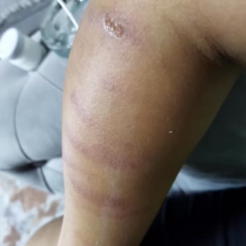 Rosso Beauty Bağcılar Şubesinde Yanıklar Ve Sınırsız Seans Sözünün İhlali