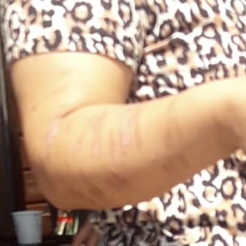 Rosso Beauty Bağcılar Şubesinde Yanıklar Ve Sınırsız Seans Sözünün İhlali