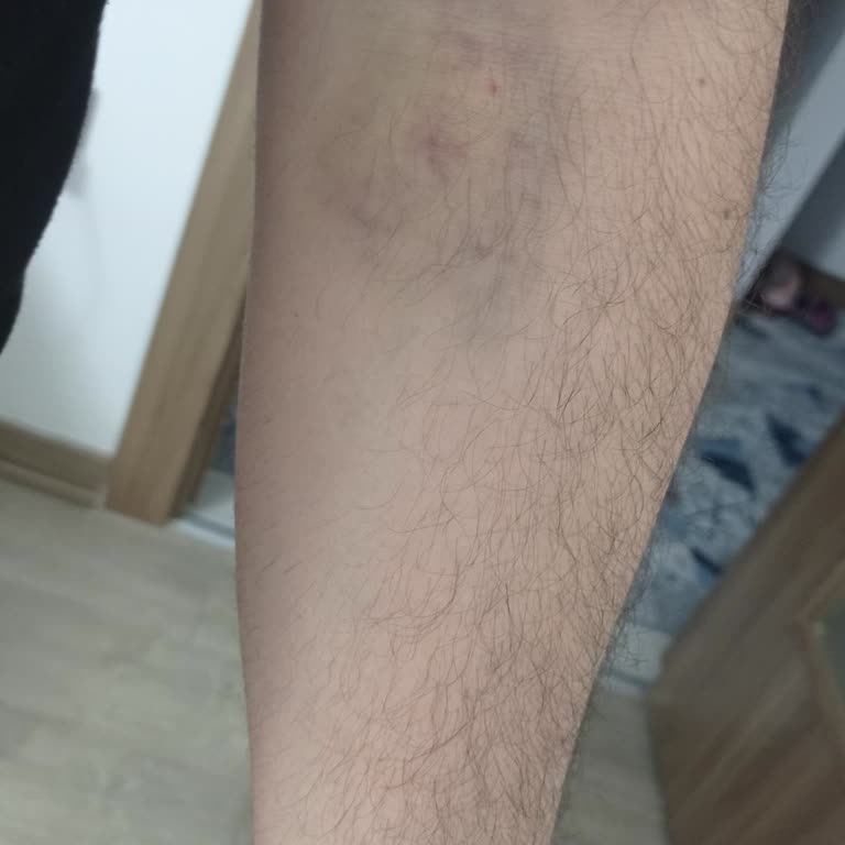 Kan Bağışı Sonrası Şiddetli Ağrı Ve Morluklar Güvenimi Sarsıyor