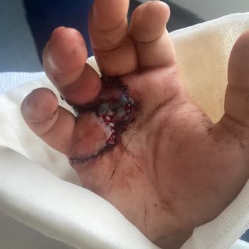 Nike Initiator Ayakkabısının Kaymaz Olmaması Nedeniyle Ciddi El Yaralanması