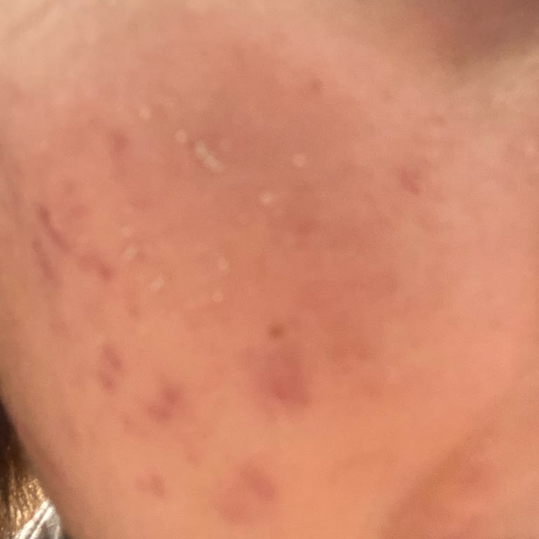 Bioderma Güneş Kreminde Ciltte Pütür Oluşması Ve Ürünün Dökülmesi Nedeniyle Ücret İadesi Talebi