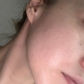 Yüz Yıkama Jelinin Ciltte Aşırı Sivilcelenmeye Neden Olması Ve Ücret İadesi Talebi