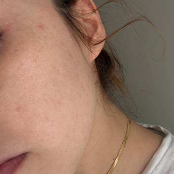 Yüz Yıkama Jelinin Ciltte Aşırı Sivilcelenmeye Neden Olması Ve Ücret İadesi Talebi