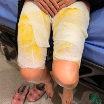 Arçelik Çay Makinesi Patladı Bacaklarım Yanık Oldu