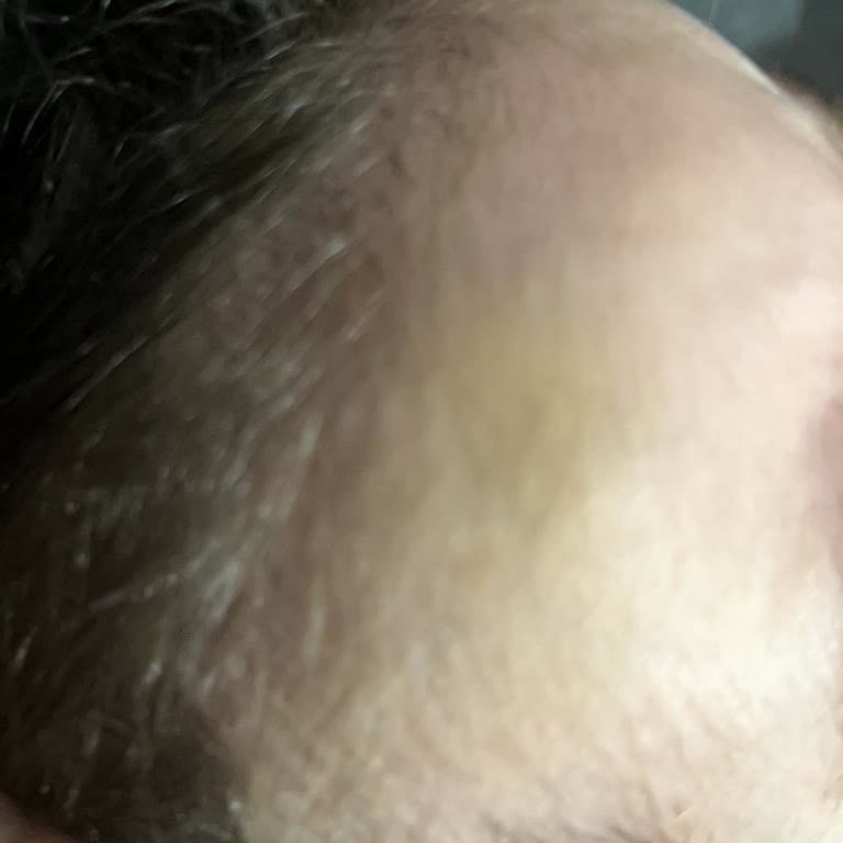 Eksik Güvenlik Parçası Nedeniyle Mama Sandalyesi Düşürülüyor Ve İade Talebi Uzuyor