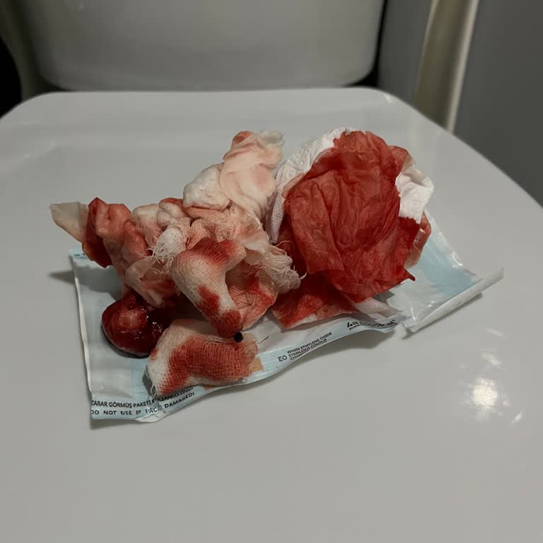 Küçükçekmece Adsh Diş Çekimi Sonrası Kanama İçin Yetersiz Müdahale Ve Sadece Bezle Eve Gönderilme