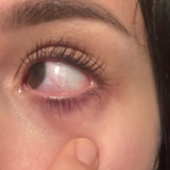 Göz Yakması Ve Yanıt Almama Nedeniyle Lens Ücretinin İadesi Talebi