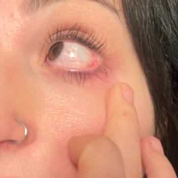 Göz Yakması Ve Yanıt Almama Nedeniyle Lens Ücretinin İadesi Talebi