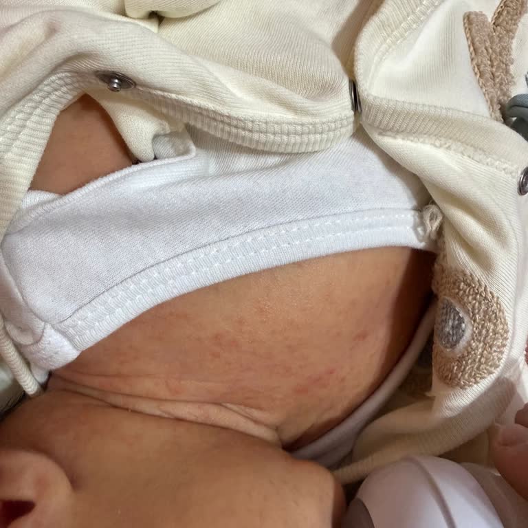 Mustela Stelatopia Kremi Bebekte Kızarıklık Ve Kabarcık Oluştu