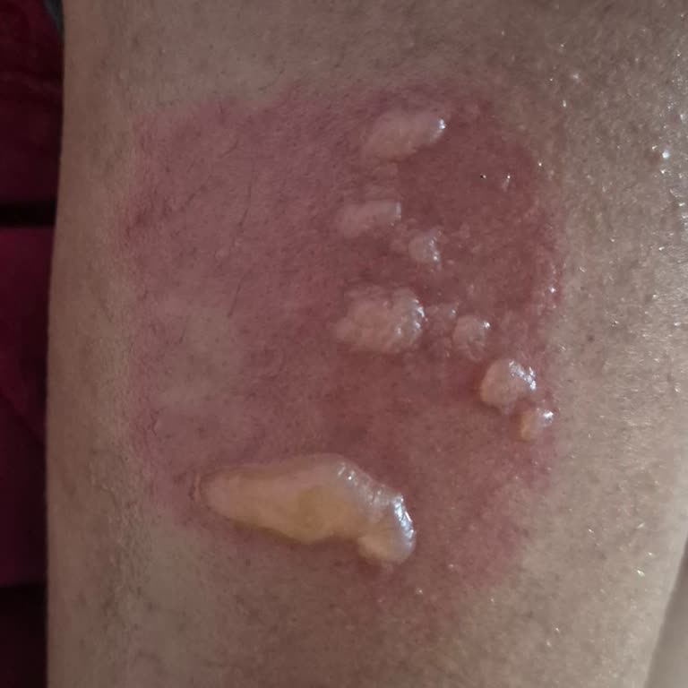 Benri Isı Bandının Cilt Yanığı Oluşturması Ve Güvenlik İncelemesi Talebi