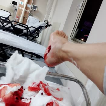 Acil Bölümde Derin Yaranın Dikiş Atılmadan Alçıyla Gönderilmesi