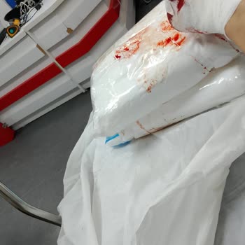 Acil Bölümde Derin Yaranın Dikiş Atılmadan Alçıyla Gönderilmesi