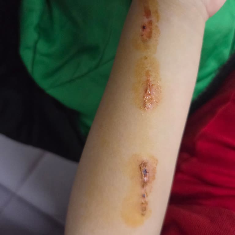 Erdem Hastanesi Kızıma Uygulanan Alçı Kesiminde Tıbbi Özensizlik Ve Doktorun Saldırgan Tutumu