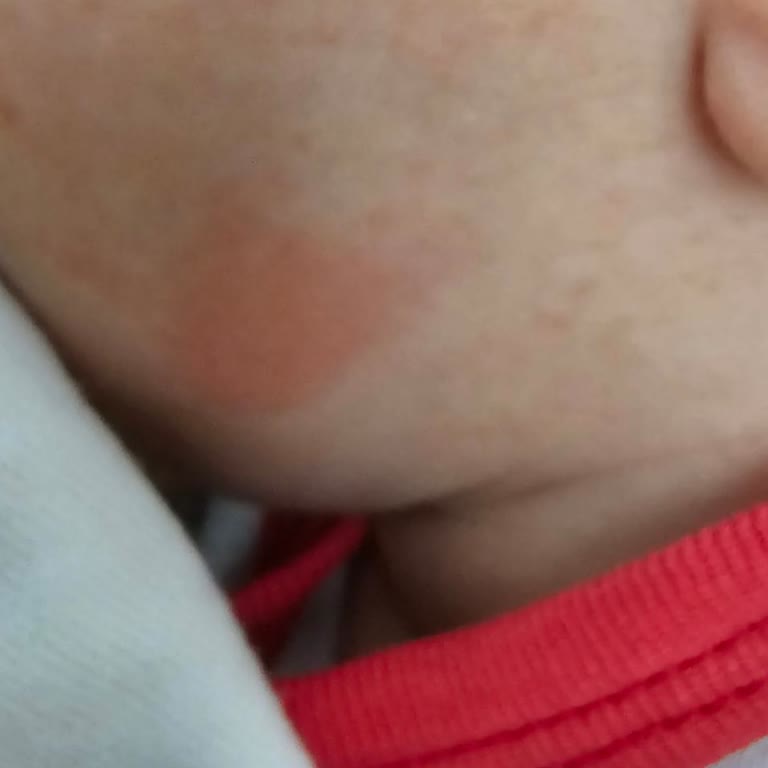 Hipp Organik Combiotic 1 Bebek Maması Kullanımından Sonra Alerjik Reaksiyon Ve İade Talebi