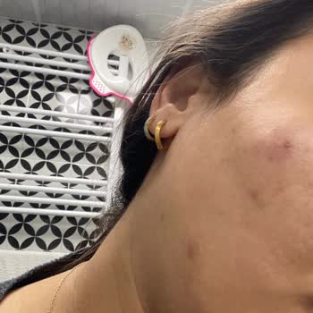 Playskin Blemish Balm Cushion Ürünü Cildimde Yanma Ve Şiddetli Sivilcelenmeye Yol Açtı