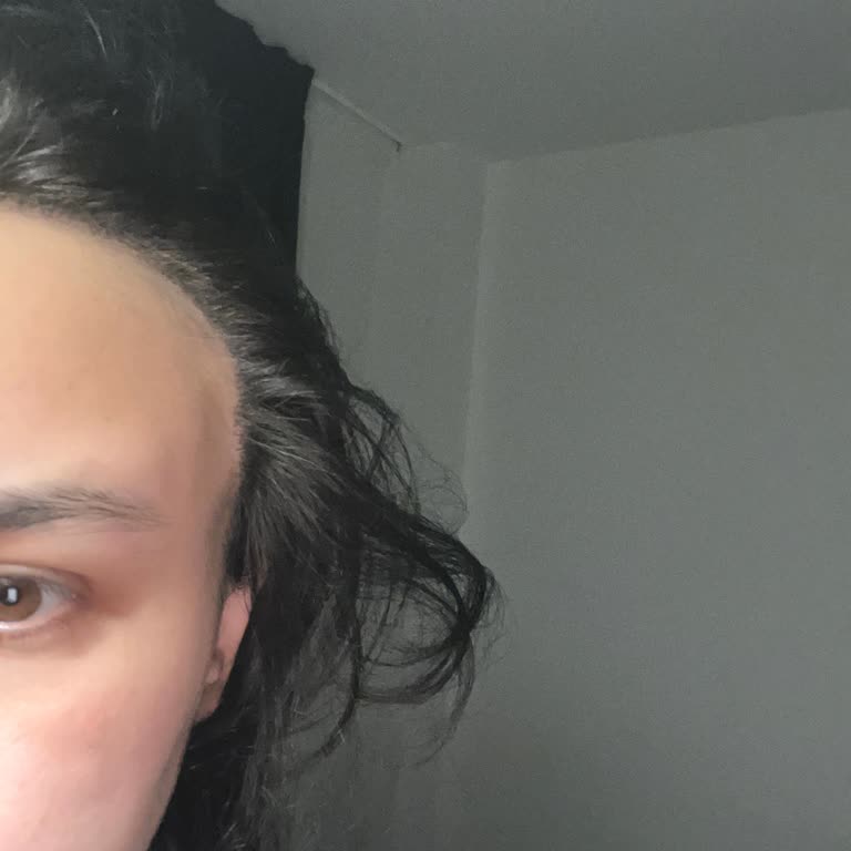 Acıbadem Ataşehir Hastanesi’nde Saç Ekimi Sonrası Doğallıktan Uzak Ve Ağrılı Sonuçlar