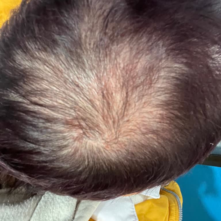 Bazekol Çiğli Hastanesi Saç Ekimi Hiçbir Şekilde Sonuç Vermedi!