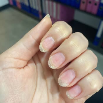 Son Dakika Personel Değişikliği Ve İlgisiz Yaklaşım Nedeniyle Tırnaklarım Kırıldı