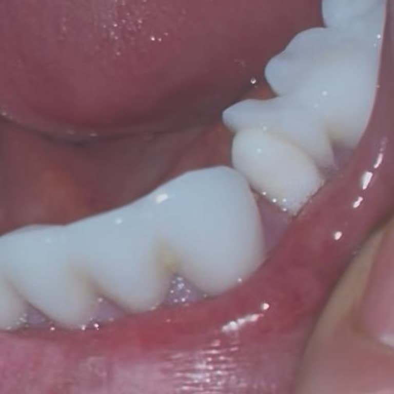 Yanıltıcı Bilgi Ve Hatalı Diş Kaplaması Sonrası Şiddetli Ağrı Ve Mağduriyet