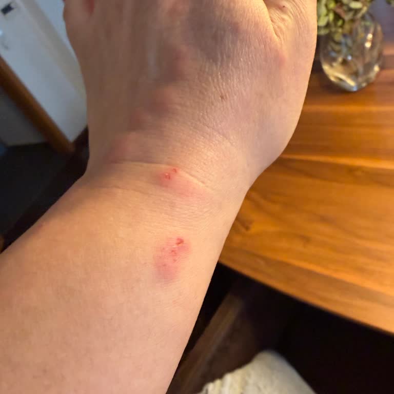 Sera Otelinde Haşere Ve Hijyen Sorunları Nedeniyle Cilt Tahrişi Ve Tatil Kırıklığı