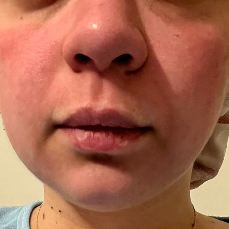 Isana 3 In 1 Yüz Maskesi Cildimi Yakıyor, İade Bekliyorum