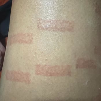 Media Markt'tan Aldığım Lazer Epilasyon Cihazı Yanması Ve İade Reddi