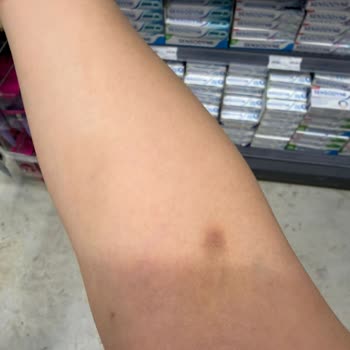 Medicana Sağlık Grubu Hemşire İki Kolda Damar Yolu Açamayıp Şiddetli Ağrıya Sebep Oldu!