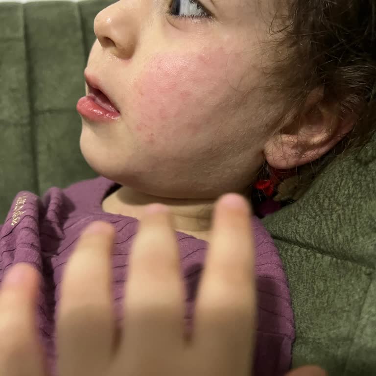 Argivit Classic Çocuğumda Alerjik Reaksiyon Ve Cilt Döküntüsü Oluşturdu