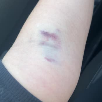 Kan Alımında Deneyimsiz Personel Nedeniyle Şiddetli Şişlik Ve Ağrı