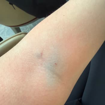 Kan Alımında Deneyimsiz Personel Nedeniyle Şiddetli Şişlik Ve Ağrı