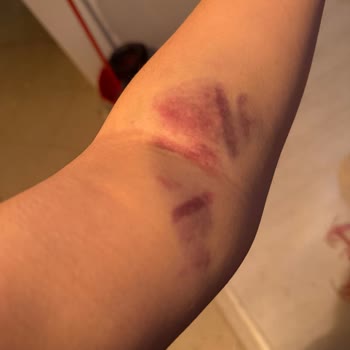 Kan Alımında Deneyimsiz Personel Nedeniyle Şiddetli Şişlik Ve Ağrı