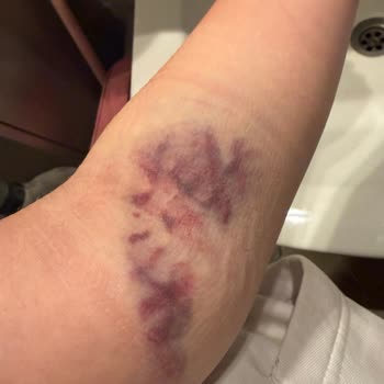 Kan Alımında Deneyimsiz Personel Nedeniyle Şiddetli Şişlik Ve Ağrı