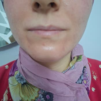 Neutrogena Yüz Temizleme Köpüğü Ciltte Şiddetli Yanma Ve Şişlik Oluşturdu