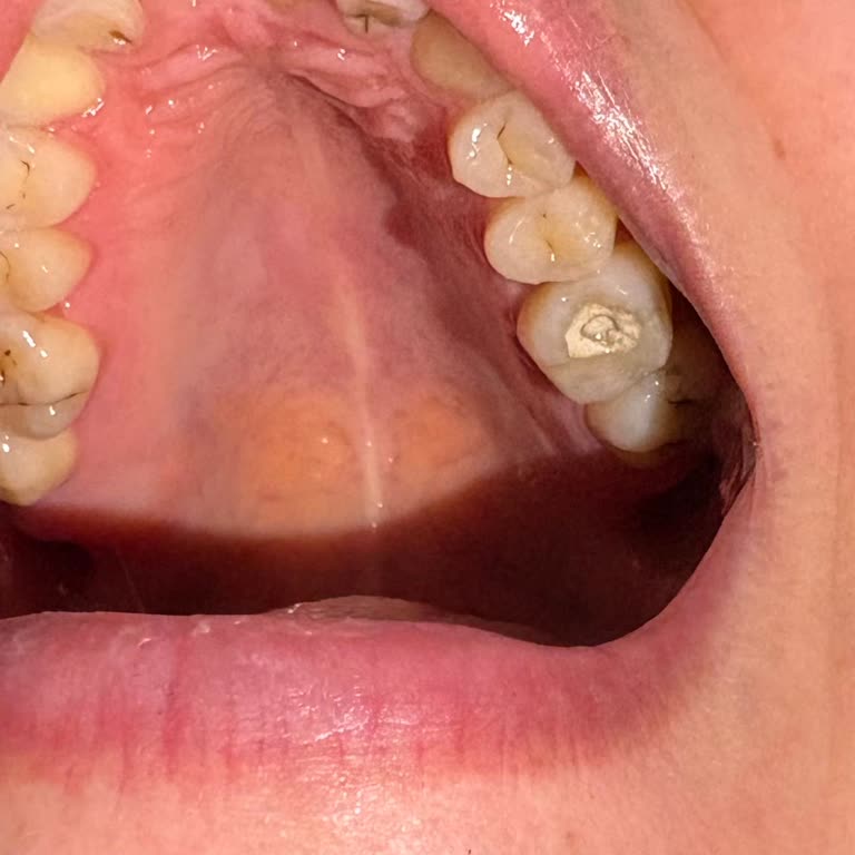 KOSTÜ ADSM Dolgu Sonrası Şiddetli Ağrı Ve Yanıltıcı Kanal Ücreti Şikayeti