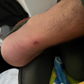 Ayıplı Spor Ayakkabı Nedeniyle Ayağımda Yara Oluştu: İade Ve Değişim Talebi