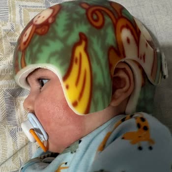Cranial Kask Alerjik Reaksiyonuna Karşı İade Reddi Ve Sorumluluk İnkarı